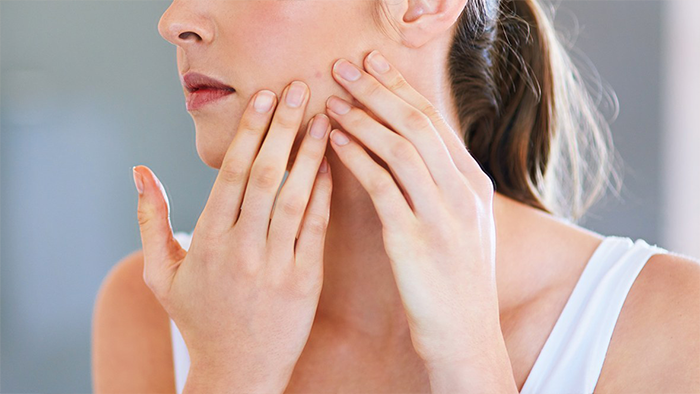 Nodules, Cysts and Acne Conglobata