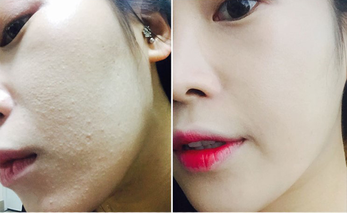 6 main causes of acne