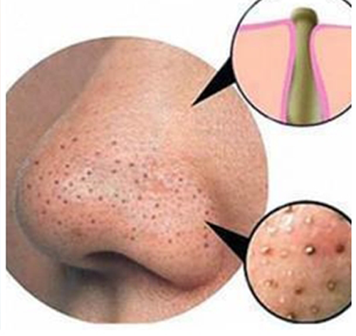 how to remove blackheads